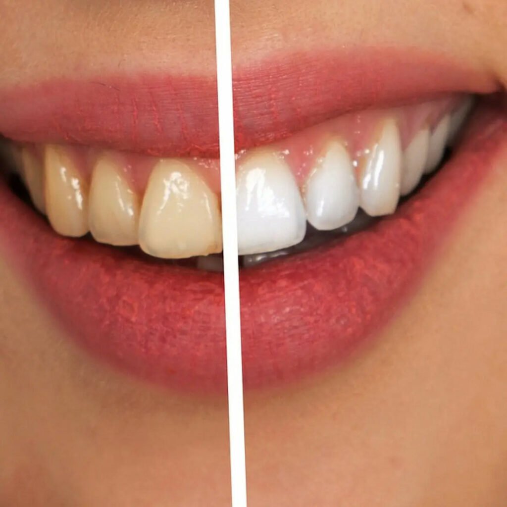 Membuat Gigi putih berseri secara alami